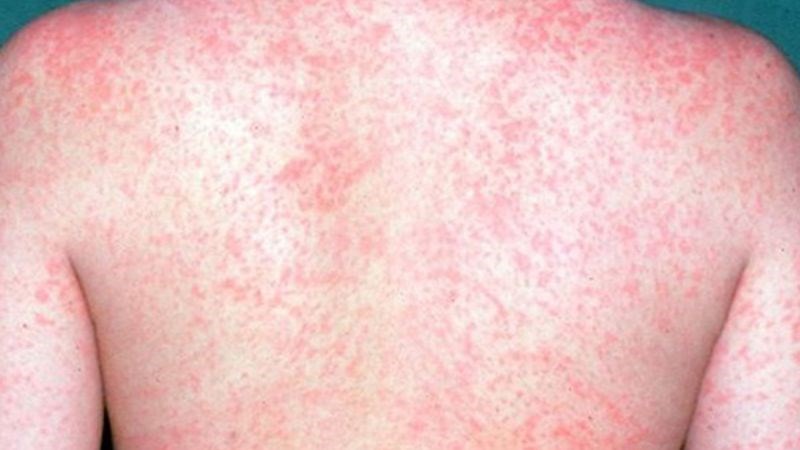 Bệnh sởi gây nhiều biến chứng nguy hiểm chưa có thuốc đặc trị, cần biết 5 khuyến cáo của Bộ Y tế